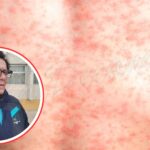 Alerta epidemiológica en San Román: Seis casos de sarampión confirmados y llamado urgente a la protección de nuestros niños