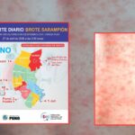 Confirman 82 casos de sarampión en Puno: mayoría se concentra en San Román y Sandia