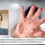 Casos confirmados de sarampión en la región Puno se elevan a 16 y Diresa intensifica vigilancia epidemiológica